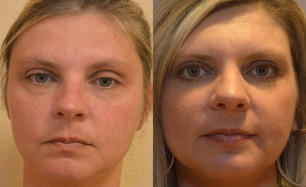Blepharoplasty before and after photo by Columbus Institute of Plastic Surgery in Columbus, OH