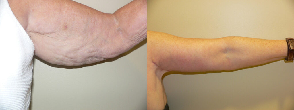 Brachioplasty (Arm Lift) before and after photo by Columbus Institute of Plastic Surgery in Columbus, OH