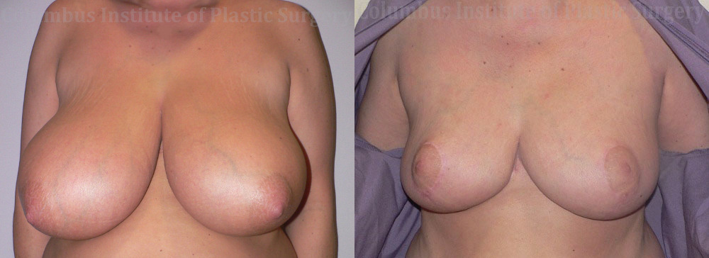 Breast Reduction before and after photo by Columbus Institute of Plastic Surgery in Columbus, OH