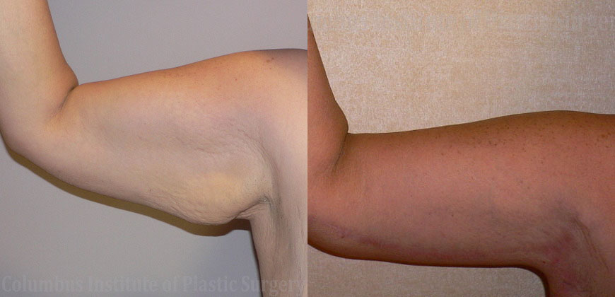 Brachioplasty (Arm Lift) before and after photo by Columbus Institute of Plastic Surgery in Columbus, OH
