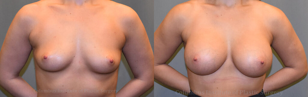 Breast Augmentation – 500cc-600cc before and after photo by Columbus Institute of Plastic Surgery in Columbus, OH
