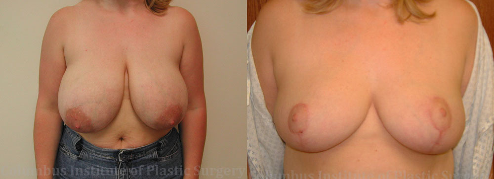 Breast Reduction before and after photo by Columbus Institute of Plastic Surgery in Columbus, OH
