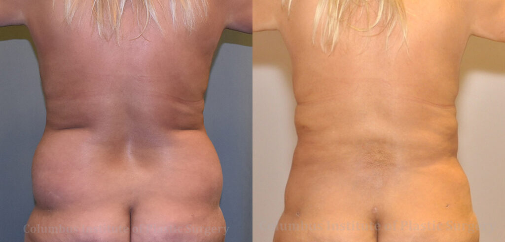 Liposuction before and after photo by Columbus Institute of Plastic Surgery in Columbus, OH