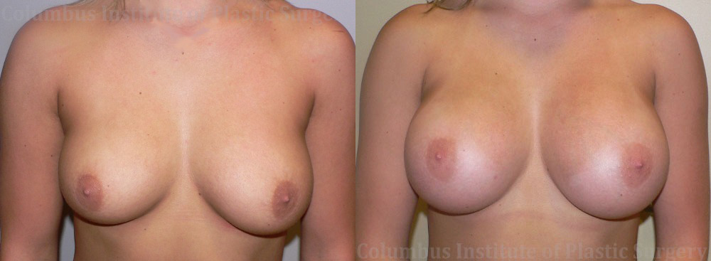 Breast Augmentation before and after photo by Columbus Institute of Plastic Surgery in Columbus, OH