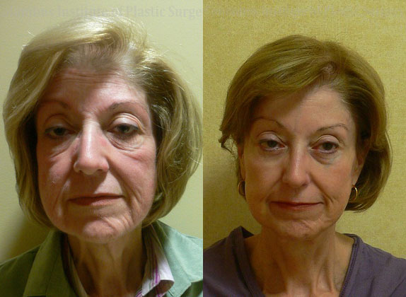 Blepharoplasty before and after photo by Columbus Institute of Plastic Surgery in Columbus, OH