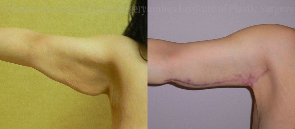 Brachioplasty (Arm Lift) before and after photo by Columbus Institute of Plastic Surgery in Columbus, OH