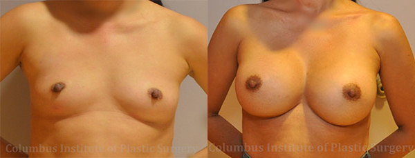 Breast Augmentation – 300cc-400cc before and after photo by Columbus Institute of Plastic Surgery in Columbus, OH
