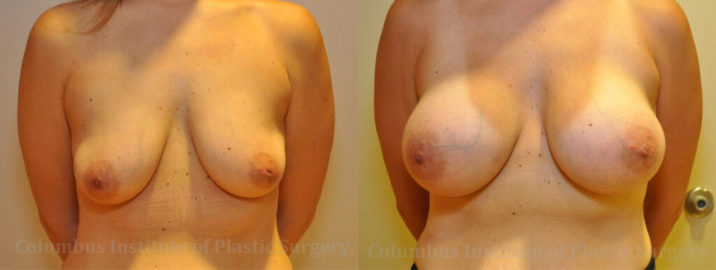 Breast Augmentation – 400cc-500cc before and after photo by Columbus Institute of Plastic Surgery in Columbus, OH