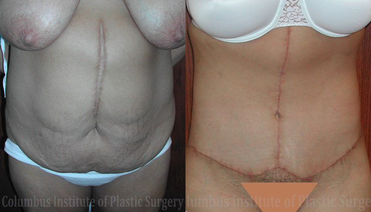 Belt Lipectomy before and after photo by Columbus Institute of Plastic Surgery in Columbus, OH