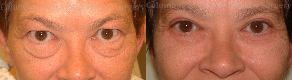 Blepharoplasty before and after photo by Columbus Institute of Plastic Surgery in Columbus, OH