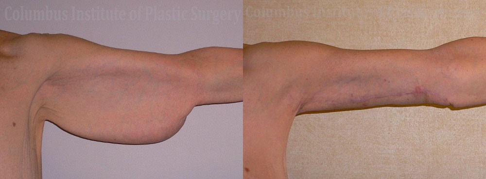 Brachioplasty (Arm Lift) before and after photo by Columbus Institute of Plastic Surgery in Columbus, OH