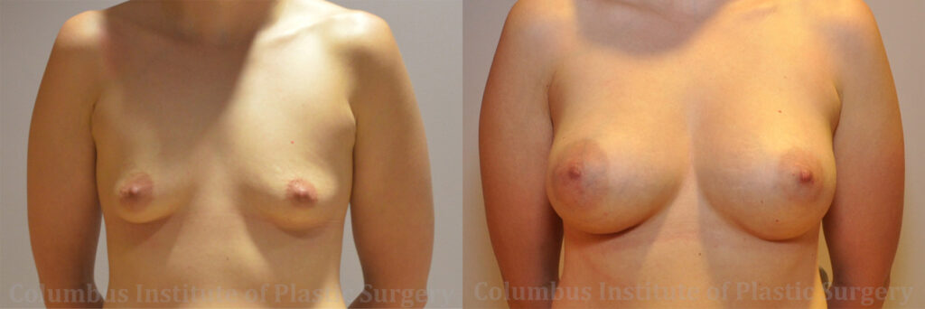 Breast Augmentation – 300cc-400cc before and after photo by Columbus Institute of Plastic Surgery in Columbus, OH