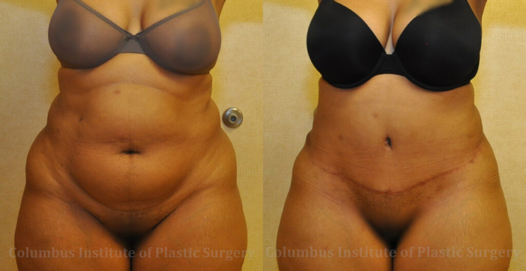 Abdominoplasty (Tummy Tuck) before and after photo by Columbus Institute of Plastic Surgery in Columbus, OH