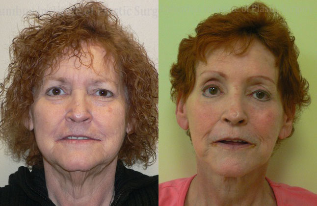 Blepharoplasty before and after photo by Columbus Institute of Plastic Surgery in Columbus, OH