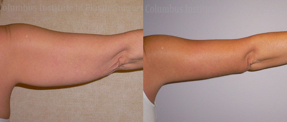 Brachioplasty (Arm Lift) before and after photo by Columbus Institute of Plastic Surgery in Columbus, OH