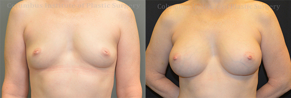 Breast Augmentation – 300cc-400cc before and after photo by Columbus Institute of Plastic Surgery in Columbus, OH