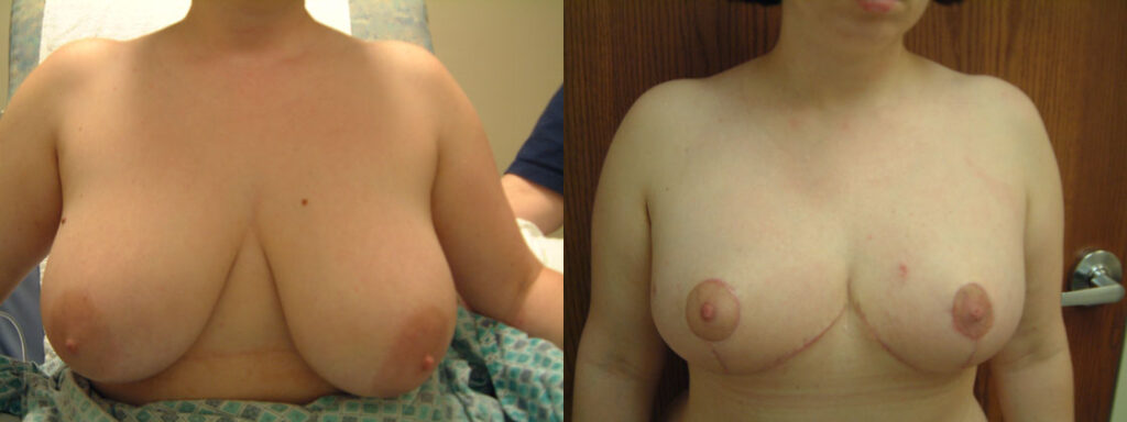 Breast Reduction before and after photo by Columbus Institute of Plastic Surgery in Columbus, OH