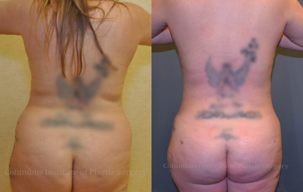 Liposuction before and after photo by Columbus Institute of Plastic Surgery in Columbus, OH