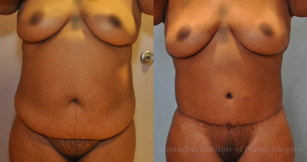 Abdominoplasty (Tummy Tuck) before and after photo by Columbus Institute of Plastic Surgery in Columbus, OH