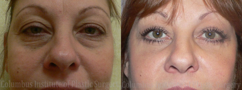 Blepharoplasty before and after photo by Columbus Institute of Plastic Surgery in Columbus, OH