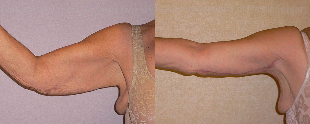 Brachioplasty (Arm Lift) before and after photo by Columbus Institute of Plastic Surgery in Columbus, OH