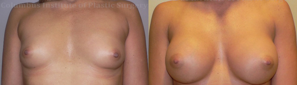 Breast Augmentation – 300cc-400cc before and after photo by Columbus Institute of Plastic Surgery in Columbus, OH