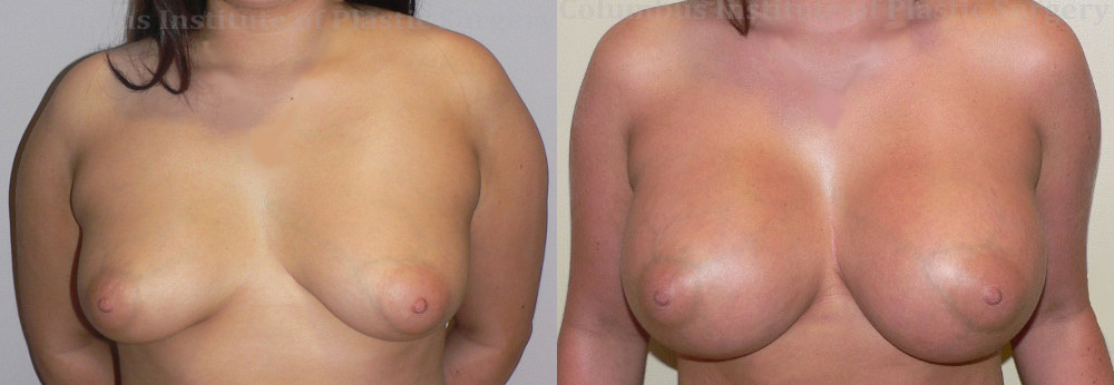 Breast Augmentation – 500cc-600cc before and after photo by Columbus Institute of Plastic Surgery in Columbus, OH