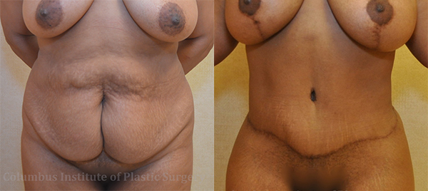 Liposuction before and after photo by Columbus Institute of Plastic Surgery in Columbus, OH