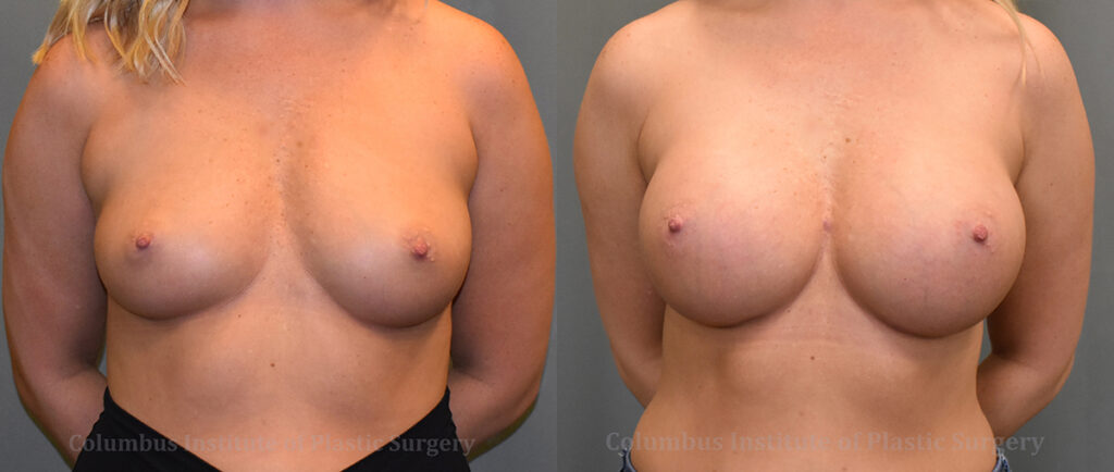 Breast Augmentation before and after photo by Columbus Institute of Plastic Surgery in Columbus, OH