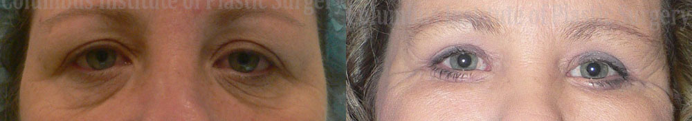 Blepharoplasty before and after photo by Columbus Institute of Plastic Surgery in Columbus, OH