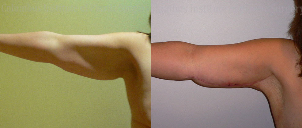 Brachioplasty (Arm Lift) before and after photo by Columbus Institute of Plastic Surgery in Columbus, OH