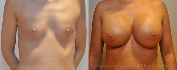 Breast Augmentation – 500cc-600cc before and after photo by Columbus Institute of Plastic Surgery in Columbus, OH