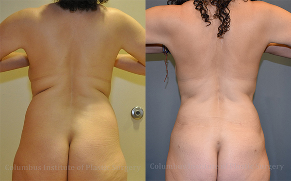 Liposuction before and after photo by Columbus Institute of Plastic Surgery in Columbus, OH