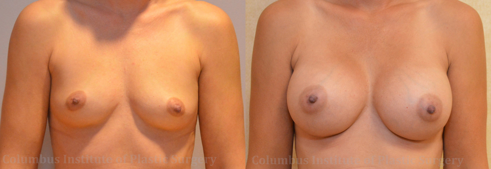 Breast Augmentation before and after photo by Columbus Institute of Plastic Surgery in Columbus, OH