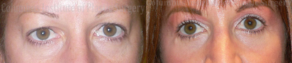 Blepharoplasty before and after photo by Columbus Institute of Plastic Surgery in Columbus, OH