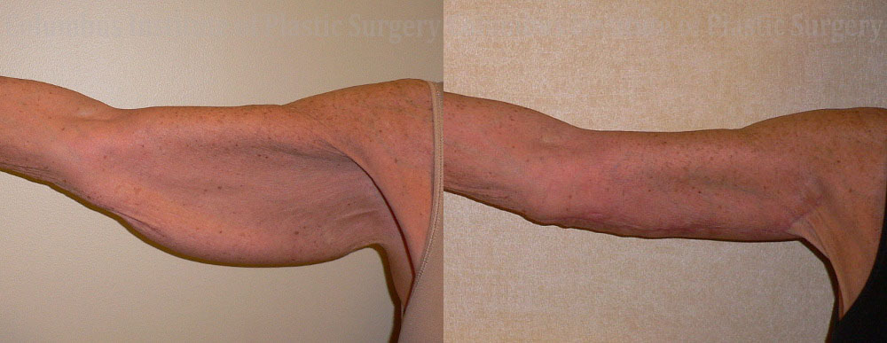 Brachioplasty (Arm Lift) before and after photo by Columbus Institute of Plastic Surgery in Columbus, OH