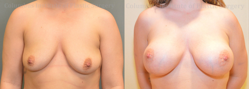 Breast Augmentation – 400cc-500cc before and after photo by Columbus Institute of Plastic Surgery in Columbus, OH