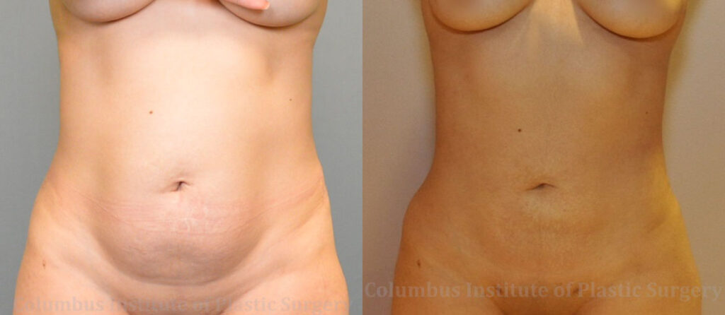 Liposuction before and after photo by Columbus Institute of Plastic Surgery in Columbus, OH