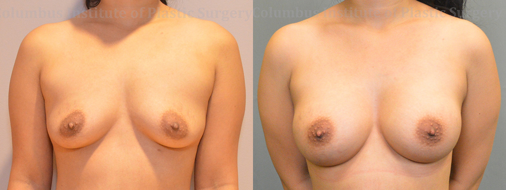 Breast Augmentation before and after photo by Columbus Institute of Plastic Surgery in Columbus, OH
