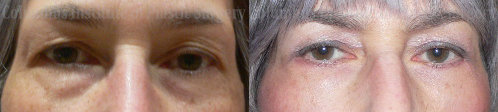 Blepharoplasty before and after photo by Columbus Institute of Plastic Surgery in Columbus, OH