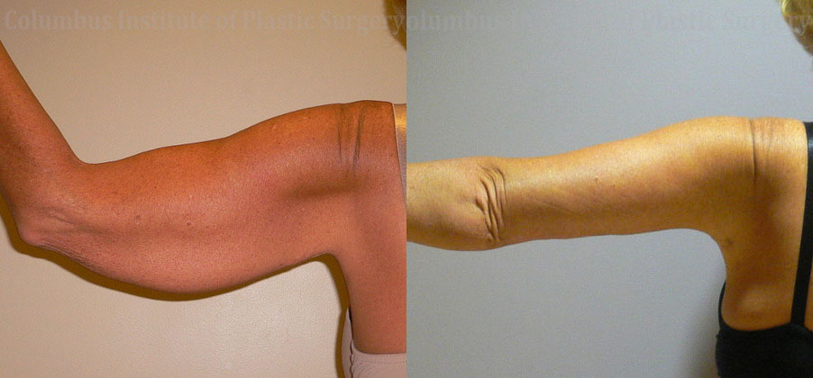 Brachioplasty (Arm Lift) before and after photo by Columbus Institute of Plastic Surgery in Columbus, OH