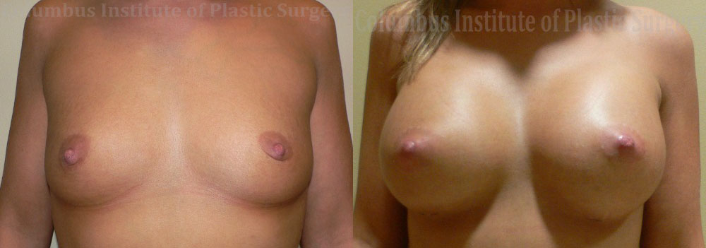 Breast Augmentation – 300cc-400cc before and after photo by Columbus Institute of Plastic Surgery in Columbus, OH