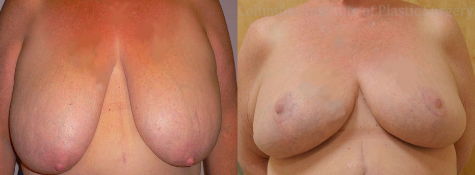 Breast Reduction before and after photo by Columbus Institute of Plastic Surgery in Columbus, OH