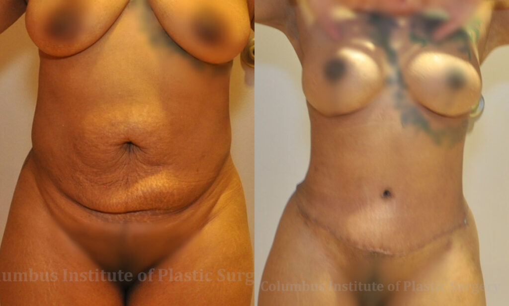 Liposuction before and after photo by Columbus Institute of Plastic Surgery in Columbus, OH
