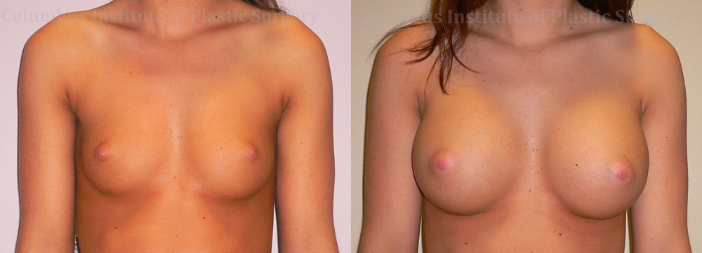 Breast Augmentation before and after photo by Columbus Institute of Plastic Surgery in Columbus, OH