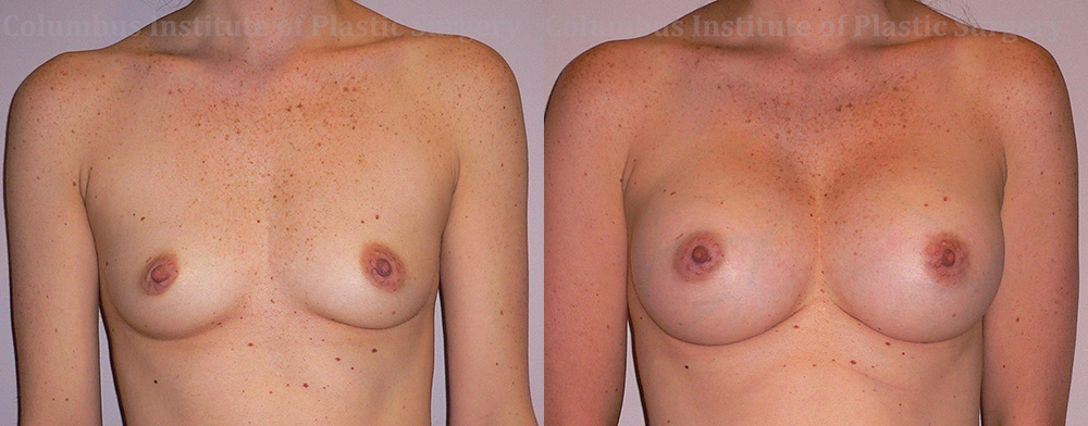 Breast Augmentation before and after photo by Columbus Institute of Plastic Surgery in Columbus, OH