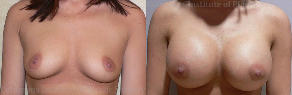 Breast Augmentation before and after photo by Columbus Institute of Plastic Surgery in Columbus, OH