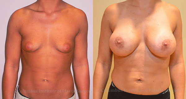 Breast Augmentation before and after photo by Columbus Institute of Plastic Surgery in Columbus, OH