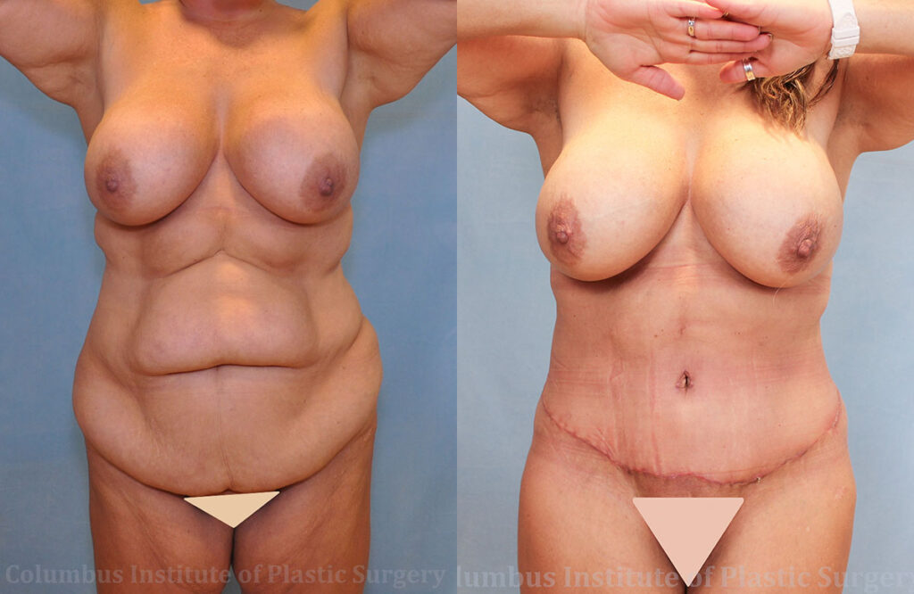 Abdominoplasty (Tummy Tuck) before and after photo by Columbus Institute of Plastic Surgery in Columbus, OH