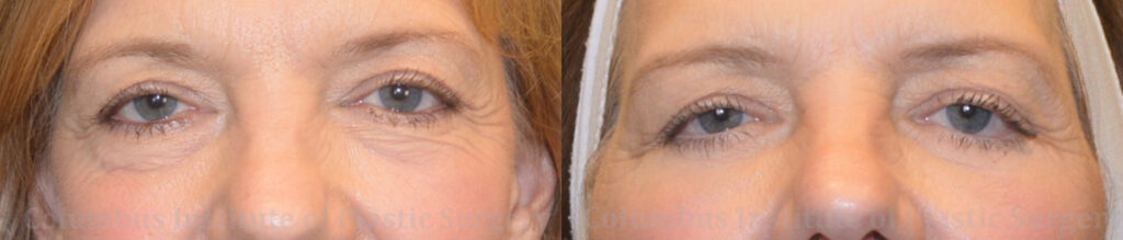 Blepharoplasty before and after photo by Columbus Institute of Plastic Surgery in Columbus, OH